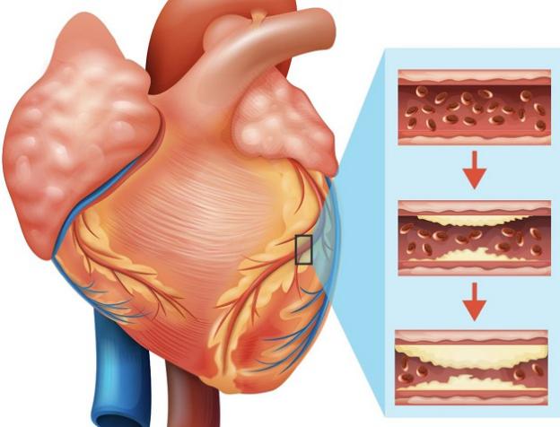 Những tác động của bệnh mạch vành đến sức khỏe và cuộc sống của người bệnh như thế nào?