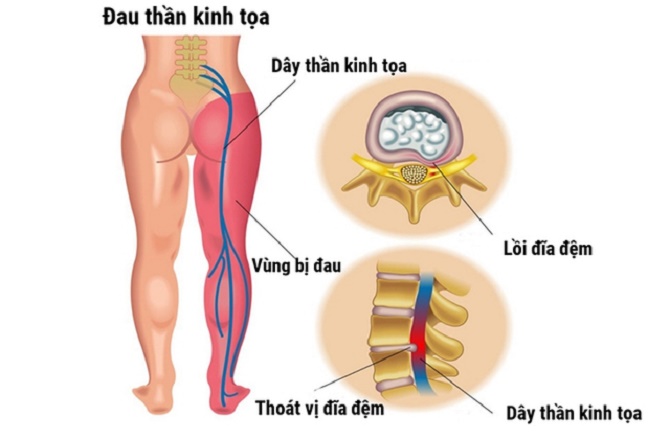 Có những biện pháp tự chăm sóc nào giúp giảm biểu hiện đau dây thần kinh tọa?
