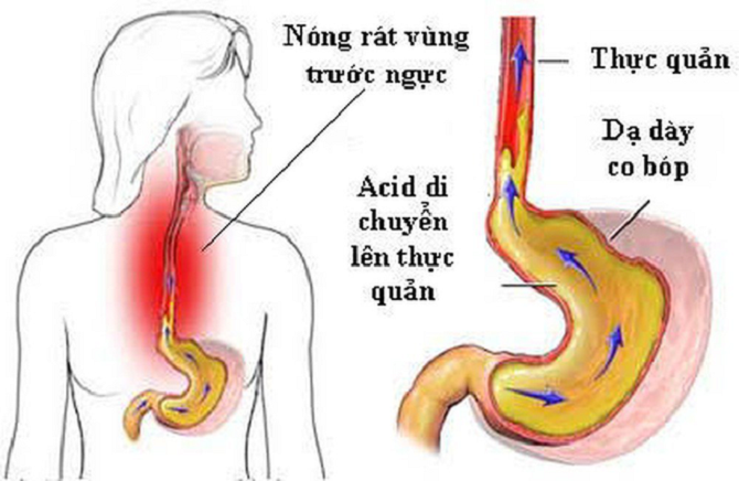 Mẹo ăn uống hạn chế triệu chứng khó chịu, người bị trào ngược dạ ...