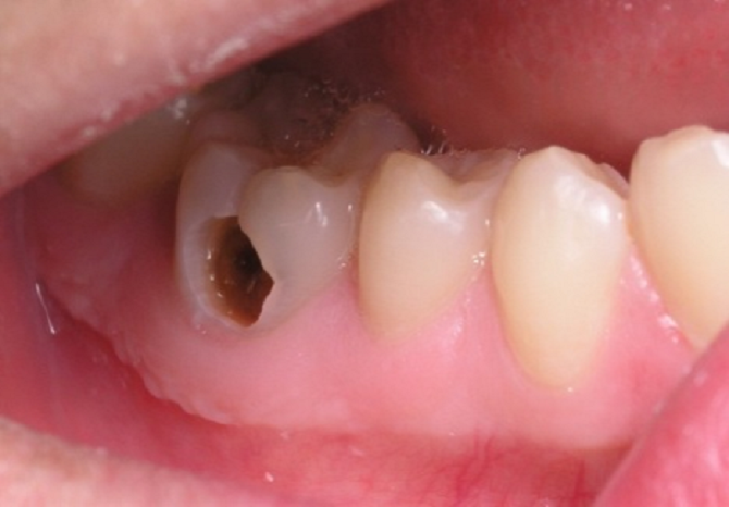 Những điều cần biết về sự an toàn và hiệu quả của thuốc nam trị đau răng?
