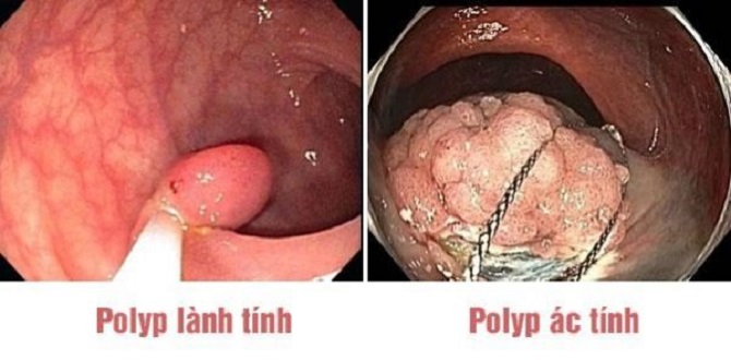 Khi nào polyp đại trực tràng thành ác tính? - Khám chữa bệnh, phổ ...