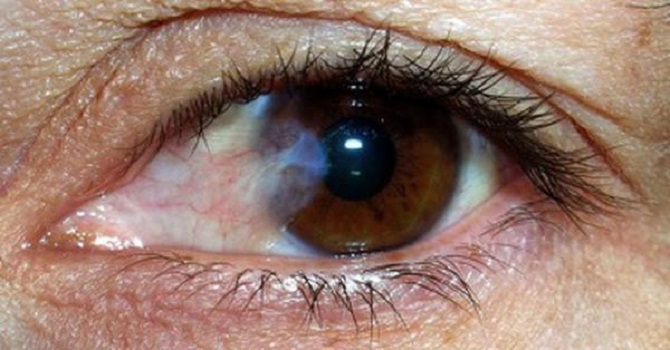 Tại sao việc sử dụng thuốc nhỏ mắt làm co mạch có thể giúp điều trị mộng thịt ở mắt?
