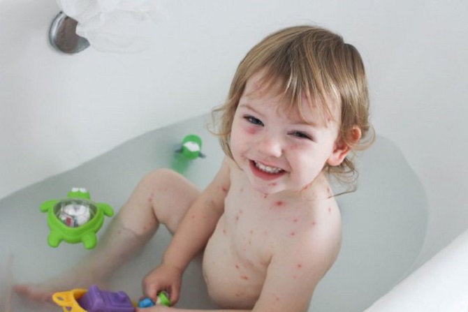 Lá gì được sử dụng để tắm trẻ bị thủy đậu?
