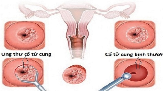 Những điều cần lưu ý khi tầm soát ung thư cổ tử cung - Tin tức sự ...