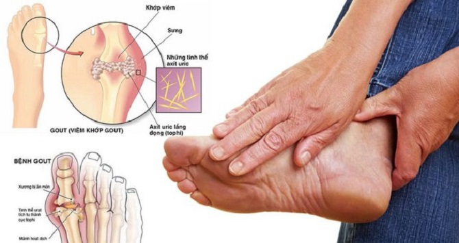 Bệnh gout cấp tính Nguyên nhân triệu chứng chẩn đoán và điều trị