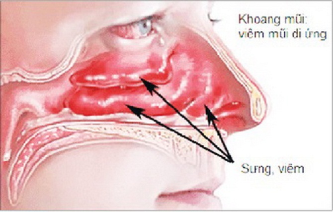 Bệnh viêm mũi dị ứng trầm trọng hơn khi bị lệch vách ngăn, xử lý ...