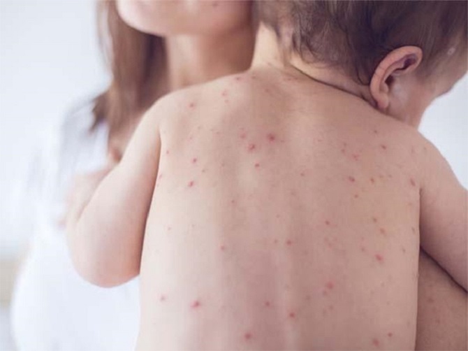 Các biến chứng do bệnh sởi gây ra có thể ảnh hưởng đến hệ miễn dịch của trẻ em như thế nào?
